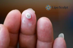 Cryopen Top 5 Treatable Conditions 4 Do you have a persistent wart of verruca that you cannot shit? Cryopen Malmesbury treatment will work call us NOW!