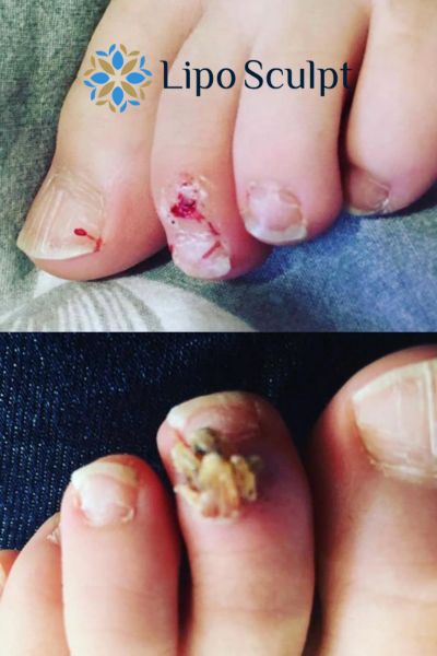 Wart removal customer results from Lipo Sculpt Malmesbury